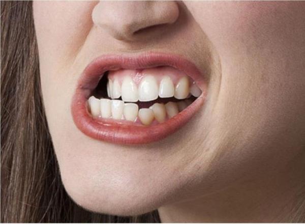 دندان قروچه یا براکسیزم دندان قروچه یا براکسیزم